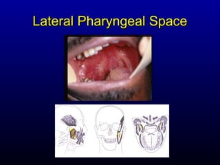 Lateral Pharyngeal Space
 