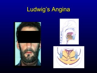 Ludwig’s Angina
 