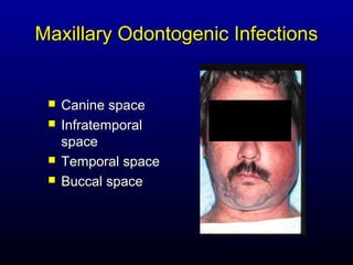 Maxillary Odontogenic Infections


    Canine space
    Infratemporal
     space
    Temporal space
    Buccal space
 