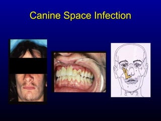 Canine Space Infection
 
