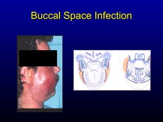 Buccal Space Infection
 