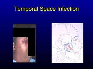 Temporal Space Infection
 