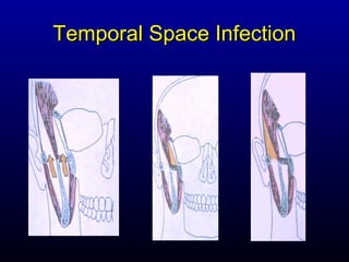Temporal Space Infection
 