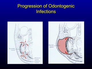 Progression of Odontogenic
        Infections
 