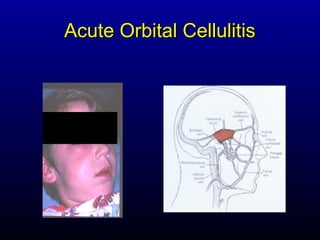 Acute Orbital Cellulitis
 