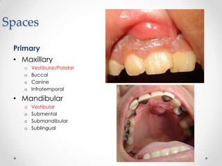Spaces
Primary
• Maxillary
o Vestibular/Palatal
o Buccal
o Canine
o Infratemporal
• Mandibular
o Vestibular
o Submental
o Submandibular
o Sublingual
 