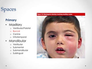 Spaces
Primary
• Maxillary
o Vestibular/Palatal
o Buccal
o Canine
o Infratemporal
• Mandibular
o Vestibular
o Submental
o Submandibular
o Sublingual
 