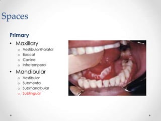 Spaces
Primary
• Maxillary
o Vestibular/Palatal
o Buccal
o Canine
o Infratemporal
• Mandibular
o Vestibular
o Submental
o Submandibular
o Sublingual
 