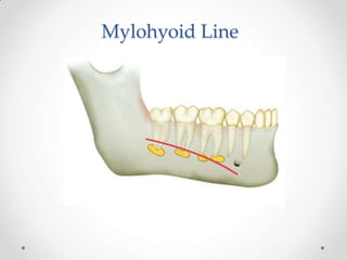 Mylohyoid Line
 