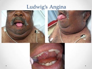 Ludwig’s Angina
 
