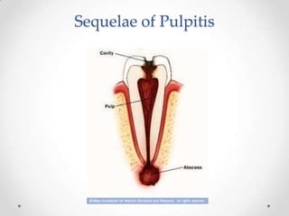 Sequelae of Pulpitis
 