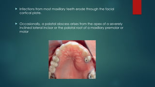 Palatal Infection Odontogenic Infections: Etiology, Pathogenesis, and Management | PPTX