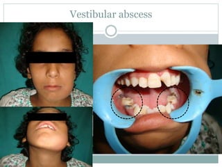 Vestibular abscess
 