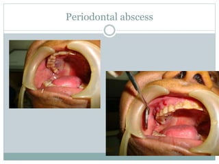 Periodontal abscess
 