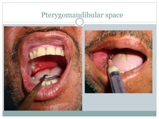 Pterygomandibular space
 