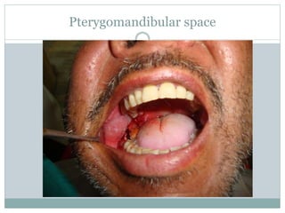 Pterygomandibular space
 