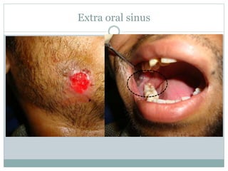 Extra oral sinus
 