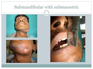 Submandibular with submassetric
 