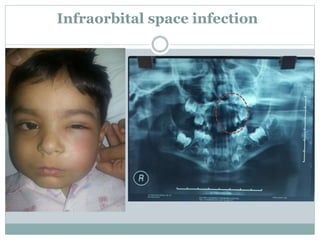 Infraorbital space infection
 