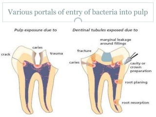Various portals of entry of bacteria into pulp
 