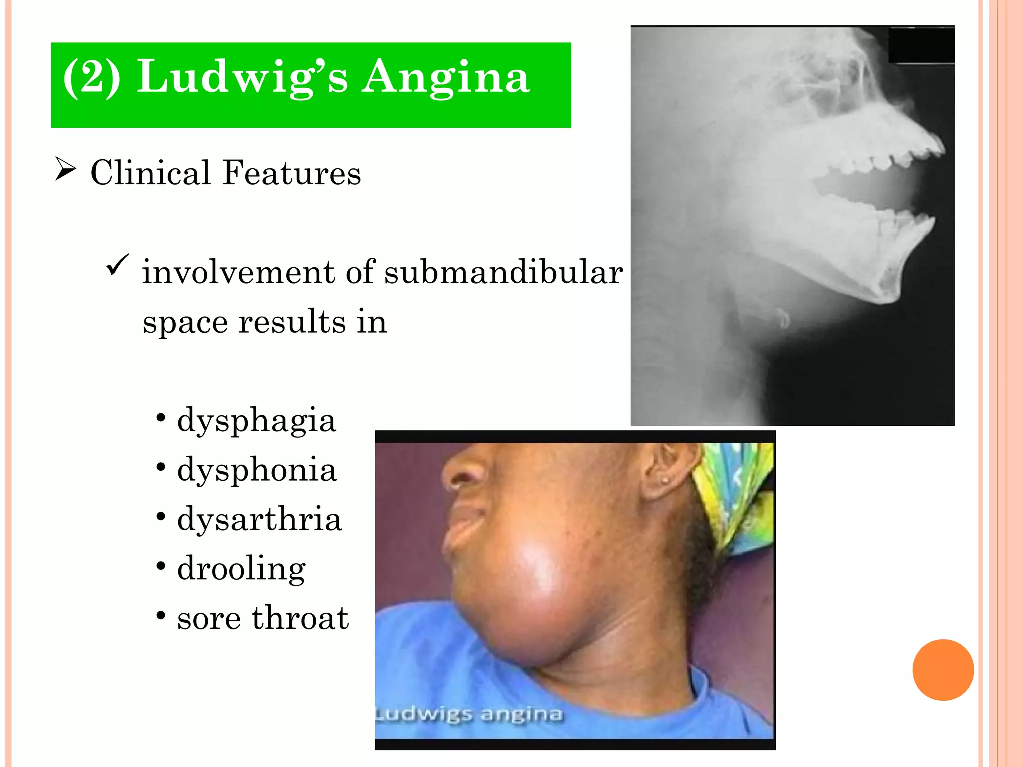 Ludwigs Odontogenic infections (4) | PPT