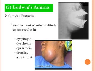 (2) Ludwig’s Angina
 Clinical Features

    involvement of submandibular
     space results in

      • dysphagia
      • dysphonia
      • dysarthria
      • drooling
      • sore throat
 