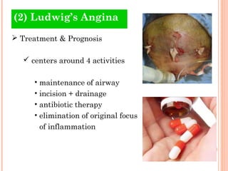(2) Ludwig’s Angina
 Treatment & Prognosis

   centers around 4 activities

     • maintenance of airway
     • incision + drainage
     • antibiotic therapy
     • elimination of original focus
       of inflammation
 