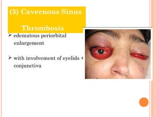 (3) Cavernous Sinus

     Thrombosis
 edematous periorbital
  enlargement

 with involvement of eyelids +
  conjunctiva
 