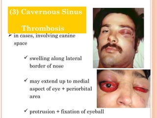 (3) Cavernous Sinus

     Thrombosis
 in cases, involving canine
  space

       swelling along lateral
          border of nose

       may extend up to medial
          aspect of eye + periorbital
          area

       protrusion + fixation of eyeball
 