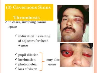 (3) Cavernous Sinus

     Thrombosis
 in cases, involving canine
  space

       induration + swelling
          of adjacent forehead
          + nose

       pupil dilation
       lacrimation         may also
       photophobia          occur
       loss of vision
 