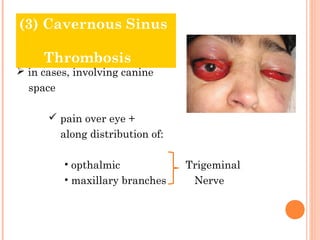 (3) Cavernous Sinus

     Thrombosis
 in cases, involving canine
  space

       pain over eye +
          along distribution of:

          • opthalmic              Trigeminal
          • maxillary branches      Nerve
 