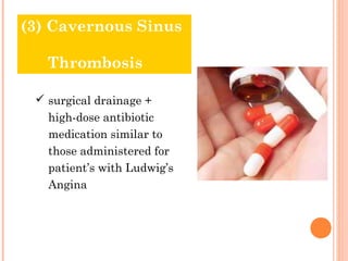 (3) Cavernous Sinus

     Thrombosis
 Treatment & Prognosis

   surgical drainage +
     high-dose antibiotic
     medication similar to
     those administered for
     patient’s with Ludwig’s
     Angina
 