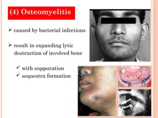 (4) Osteomyelitis

 caused by bacterial infections

 result in expanding lytic
  destruction of involved bone

    with suppuration
    sequestra formation
 
