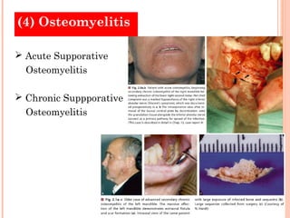 (4) Osteomyelitis

 Acute Supporative
  Osteomyelitis

 Chronic Suppporative
  Osteomyelitis
 