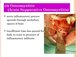(4) Osteomyelitis
  (Acute Supporative Osteomyelitis)
 acute inflammatory process
  spreads through medullary
  spaces of bone

 insufficient time has passed for
  body to react to presence of
  inflammatory infiltrate
 