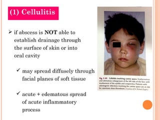 (1) Cellulitis

 if abscess is NOT able to
  establish drainage through
  the surface of skin or into
  oral cavity

    may spread diffusely through
     facial planes of soft tissue

    acute + edematous spread
     of acute inflammatory
     process
 