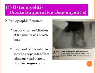 (4) Osteomyelitis
  (Acute Supporative Osteomyelitis)
 Radiographic Features

   on occasion, exfoliation
     of fragments of necrotic
     bone

   fragment of necrotic bone
     that has separated from
     adjacent vital bone is
     teremed sequestrum
 