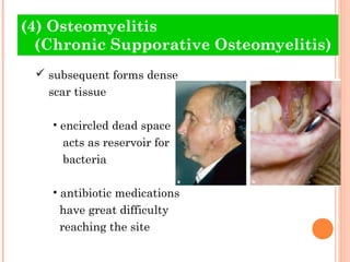 (4) Osteomyelitis
  (Chronic Supporative Osteomyelitis)
  subsequent forms dense
   scar tissue

   • encircled dead space
     acts as reservoir for
     bacteria

   • antibiotic medications
     have great difficulty
     reaching the site
 