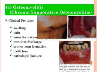 (4) Osteomyelitis
  (Chronic Supporative Osteomyelitis)
 Clinical Features

    swelling
    pain
    sinus formation
    purulent discharge
    sequestrum formation
    tooth loss
    pathologic fracture
 