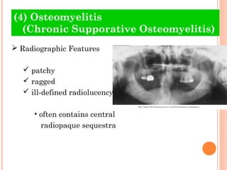 (4) Osteomyelitis
  (Chronic Supporative Osteomyelitis)
 Radiographic Features

   patchy
   ragged
   ill-defined radiolucency

     • often contains central
       radiopaque sequestra
 