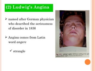 (2) Ludwig’s Angina

 named after German physician
  who described the seriousness
  of disorder in 1836

 Angina comes from Latin
  word angere

   strangle
 