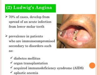 (2) Ludwig’s Angina
 70% of cases, develop from
  spread of an acute infection
  from lower molar teeth

 prevalence in patients
  who are immunocompromised
  secondary to disorders such
  as:

    diabetes mellitus
    organ transplantation
    acquired immunodeficiency syndrome (AIDS)
    aplastic anemia
 