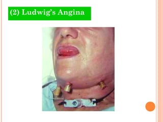 (2) Ludwig’s Angina
 