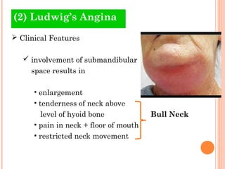 (2) Ludwig’s Angina
 Clinical Features

    involvement of submandibular
     space results in

      • enlargement
      • tenderness of neck above
        level of hyoid bone             Bull Neck
      • pain in neck + floor of mouth
      • restricted neck movement
 