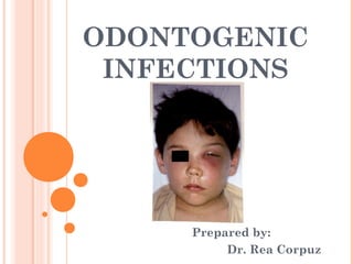 ODONTOGENIC
 INFECTIONS




     Prepared by:
          Dr. Rea Corpuz
 