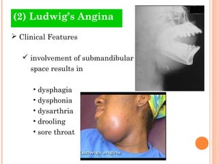 (2) Ludwig’s Angina
 Clinical Features

    involvement of submandibular
     space results in

      • dysphagia
      ...