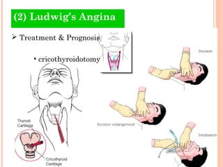 (2) Ludwig’s Angina
 Treatment & Prognosis

     • cricothyroidotomy
 