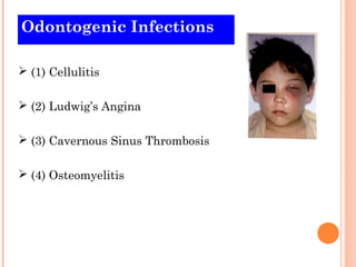 Odontogenic Infections

 (1) Cellulitis

 (2) Ludwig’s Angina

 (3) Cavernous Sinus Thrombosis

 (4) Osteomyelitis
 