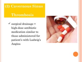 (3) Cavernous Sinus

     Thrombosis
 Treatment & Prognosis

   surgical drainage +
     high-dose antibiotic
     medic...