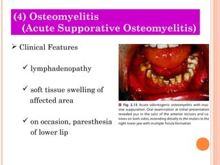 (4) Osteomyelitis
  (Acute Supporative Osteomyelitis)
 Clinical Features

    lymphadenopathy

    soft tissue swelling...